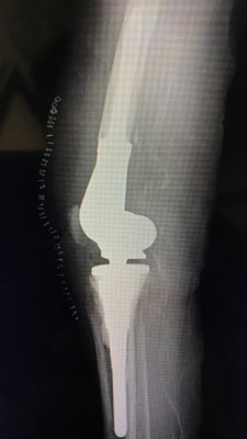 Revision Knee Surgery