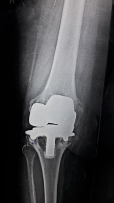 Failed Knee Surgery