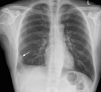 Pulmonary Embolism X-ray