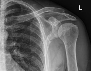 shoulder ap x-ray