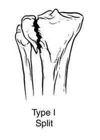 Split Fracture involving the Lateral Condyle