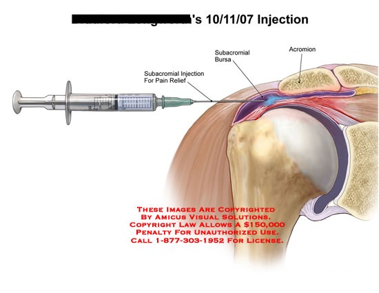 Subacromial Bursa Injection Technique