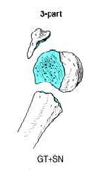 three part fracture of proximal humerus 1