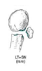 three part fracture of proximal humerus 2