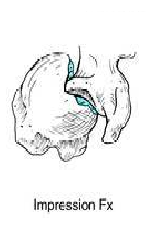 three part fracture of proximal humerus 3