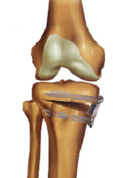 Tibial Osteotomy