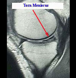 Torn Medial Meniscus MRI