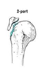 two part fracture of proximal humerus 1