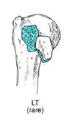 two part fracture of proximal humerus 2