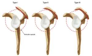 types of acromion