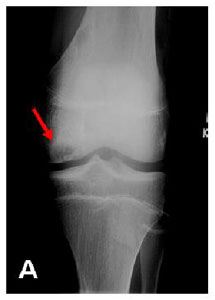 X-ray of Arthroscopic Articular Cartilage Repair