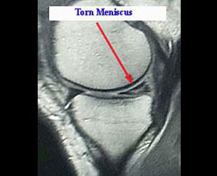 Torn Medial Meniscus MRI