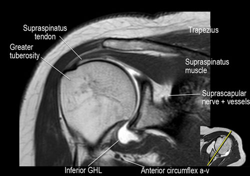 Normal Shoulder MRI