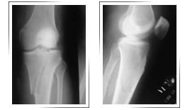 Fracture Tibial Plateau Before Surgery