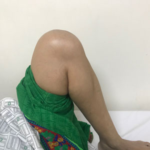 Post Operative Knee Fold