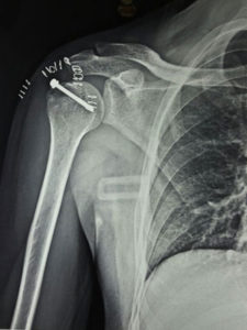 Fractures around Shoulder After Surgery