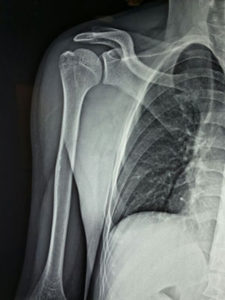 Fractures around Shoulder Before Surgery