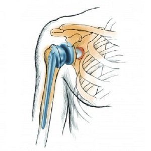 Total Shoulder Replacement Surgery