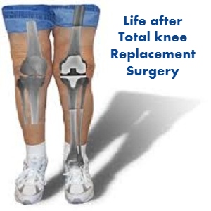 Life after Total knee Replacement Surgery (
