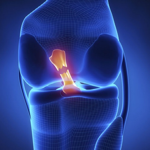 Anterior Cruciate Ligament (ACL) Injuries