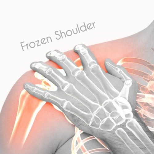 Everything about Frozen Shoulder (1)