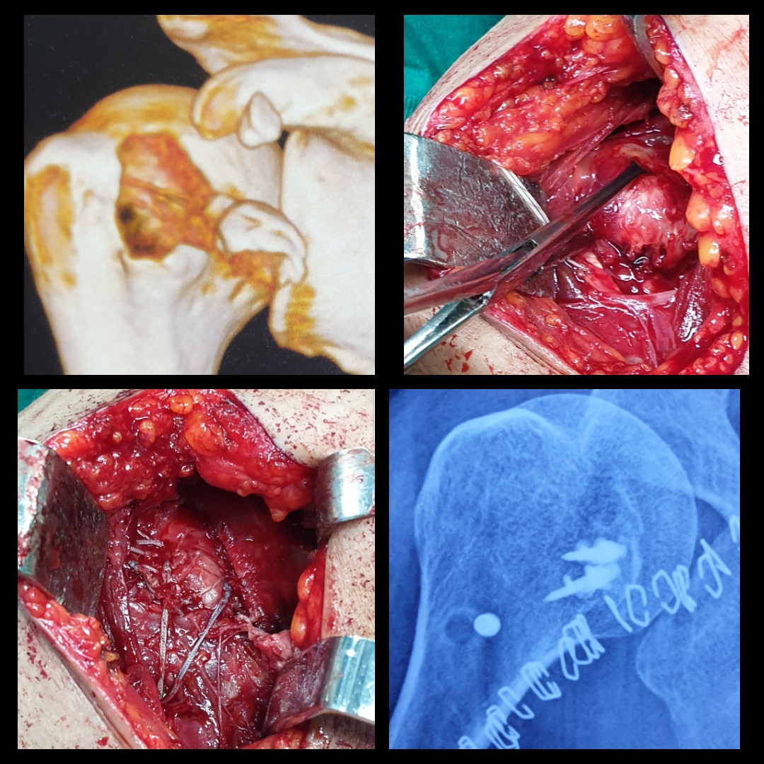 Open Fixation of the Avulsion Fracture