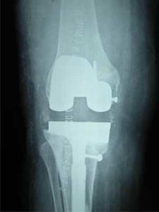 Post Operation X-Ray for Revision Total Knee Replacement Surgery