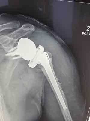 Post Reverse Shoulder Replacement Surgery X-Ray for Complex Fracture