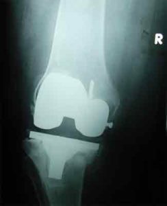 Pre-Operation X-Ray for Revision Total Knee Replacement Surgery