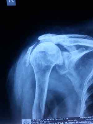 Pre Shoulder Replacement Surgery X-Ray for Rotator Cuff Arthropathy