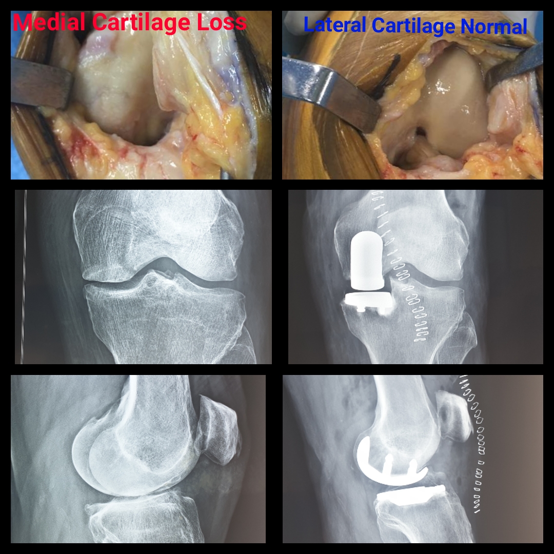 85-yr-old patient on whom Partial Knee Replacement was performed by Dr. Amyn Rajani