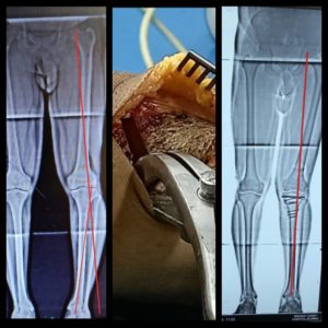 Reviving the Forgotten Art of Open Wedge High Tibial Osteotomy