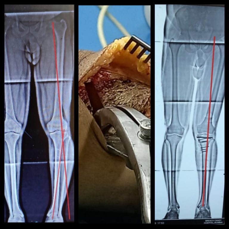 Reviving the Art of Open Wedge High Tibial Osteotomy Knee
