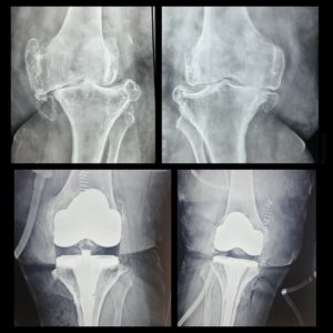 Single-Stage Bilateral Total Knee Replacement Surgery Success 