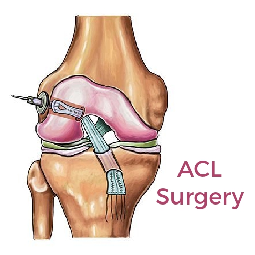 Do You Know What Happens During an ACL Surgery?