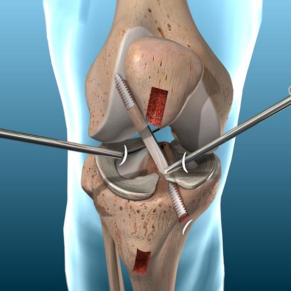 ACL Surgery-Rebuilding a Torn Anterior Cruciate Ligament