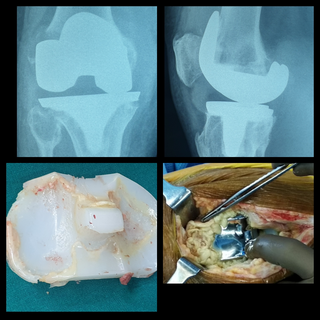 Revised Total Knee Replacement Surgery of a 75 yrs old Male By Dr. Amyn Rajani