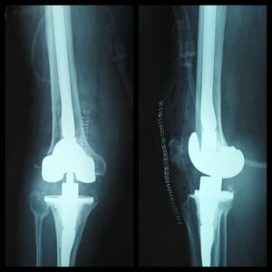 Revised Total Knee Replacement Surgery of a 75 yrs old Male By Dr. Amyn Rajani