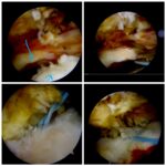 Repairing Shoulder Tear of a 65-years-old Patient During COVID-19