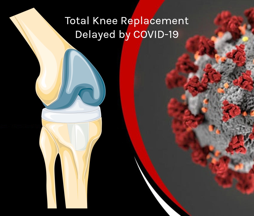 Total Knee Replacement Patients Delayed by COVID-19