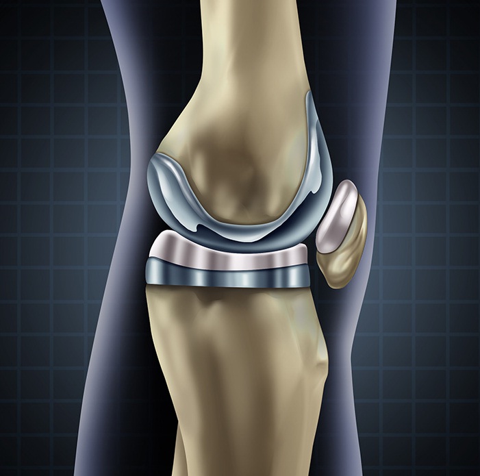 How Is Knee Replacement Surgery Performed