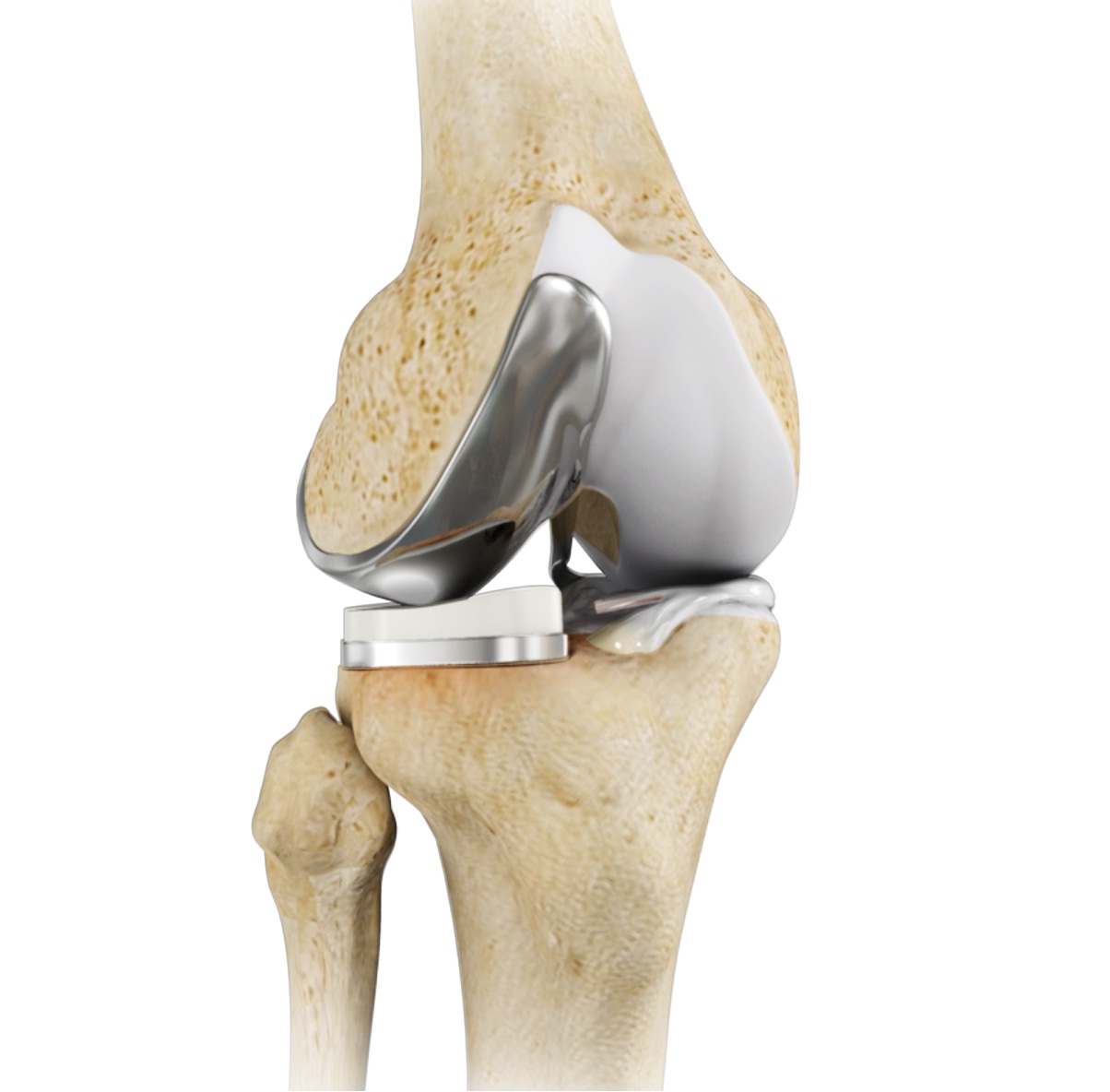 Is Partial Knee Joint Replacement For You?