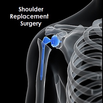 Shoulder Replacement Surgery