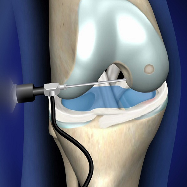 Utility Of Arthroscopy For Knee Treatment
