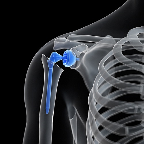 Risks And Complications Of Shoulder Joint Replacement Surgery