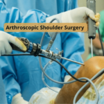 Arthroscopic Shoulder Surgery - Fast Recovery, Smaller Scars