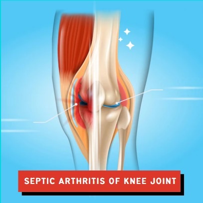 Management Of Septic Arthritis Of Knee Joint