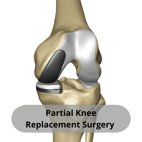 Partial Knee Replacement Surgery – An Alternative Surgery