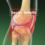 Septic Arthritis After Knee Joint Replacement