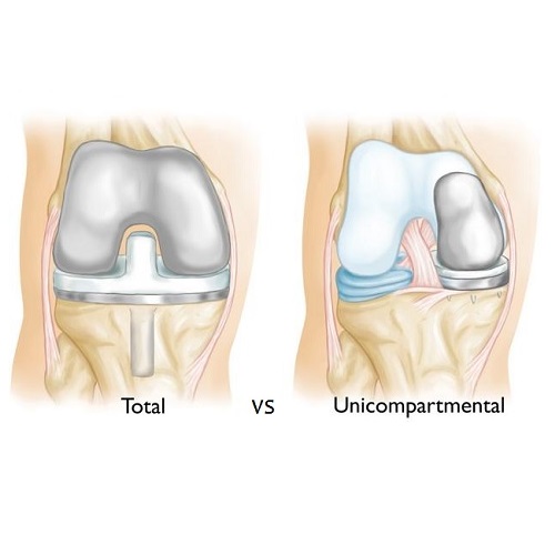 Partial Vs Total Knee Replacement